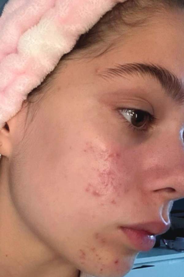 Customer skin before