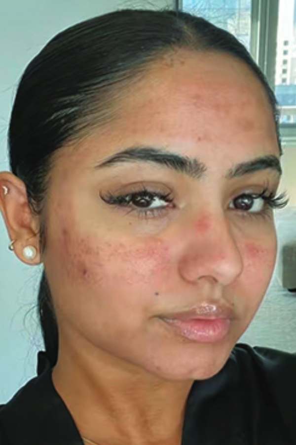 Customer skin before