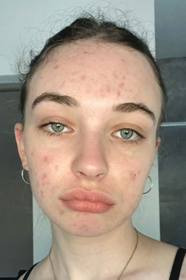Customer skin before