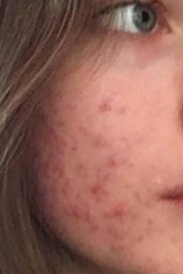 Customer skin before